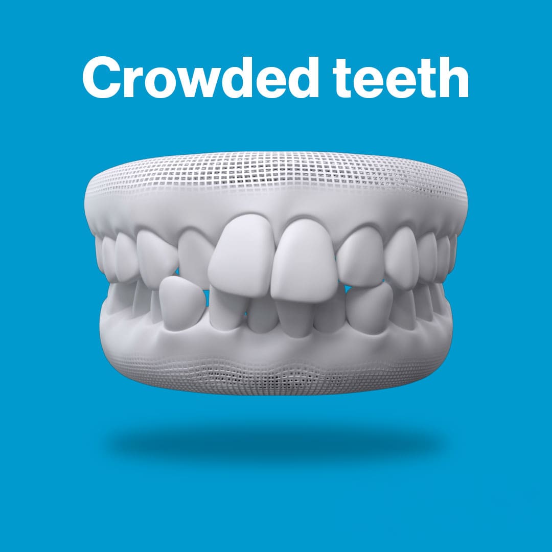 crowded-teeth