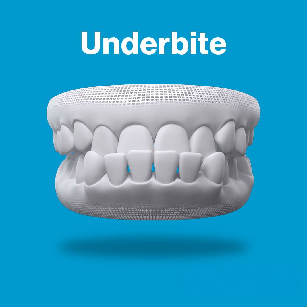 underbite