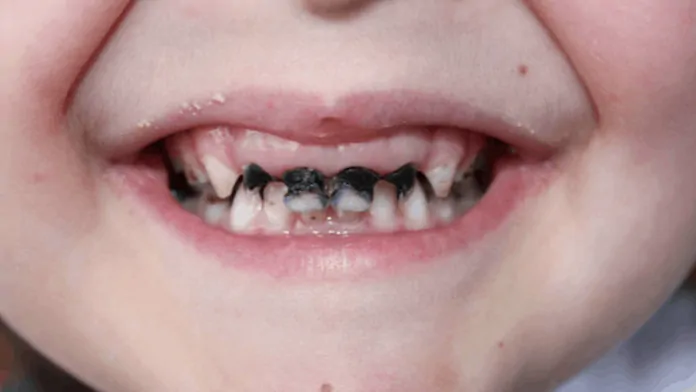Diş Çürükleri Nasıl Oluşur?