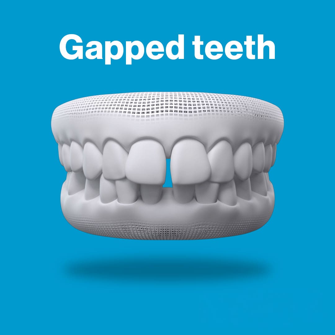 Gapped-teeth